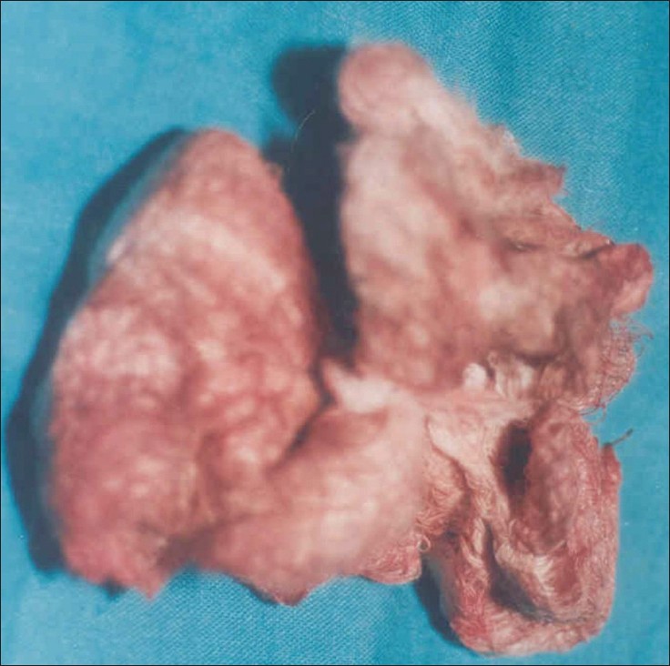 Figure 2: Shows the extracted gauze in case 2