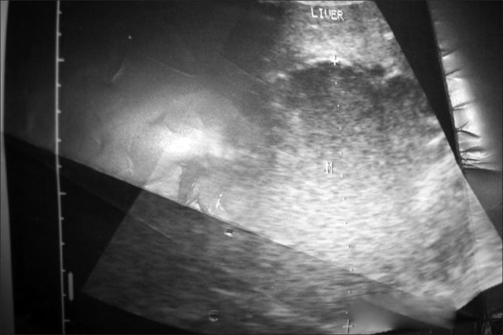 Figure 1: Ultrasound scan of the liver prior to surgery