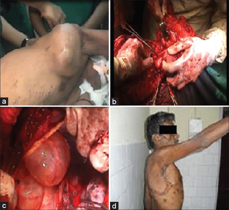 Figure 1: (a) Preoperative photo of the patient. (b) Photo showing
tumor arising from the lateral thoracic nerve. (c) Photo showing lateral
thoracic meningoceles. (d) Postoperative photo of the patient