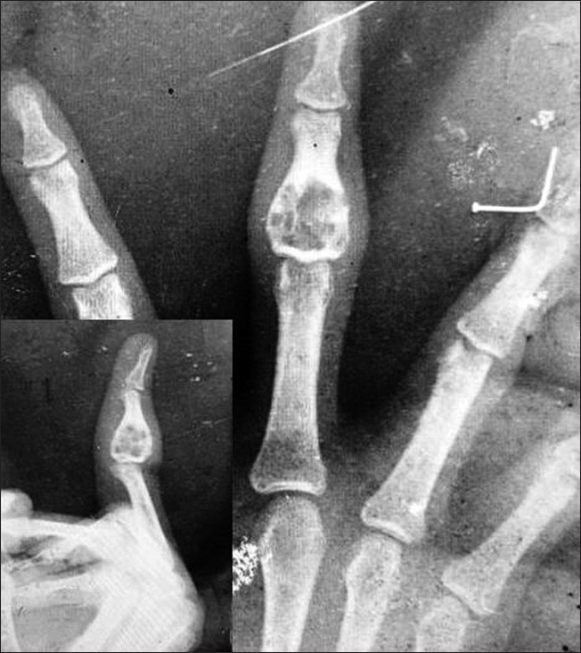 Figure 1: X‑ray showing a lytic, radiolucent, lobulated lesion with
cortical expansion, a sclerotic rim, and septations at the base of the
middle phalanx of the left middle finger. No calcification or periosteal
reaction is noted