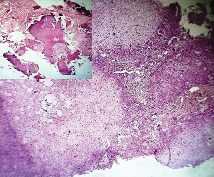 Figure 2: Tumor having a lobular pattern of growth of spindle shaped
and stellate cells, with abundant myxoid and chondroid intercellular
material; H and E ×100 (inset: Lamellar bony trabeculae showing no
significant pathology; ×100)