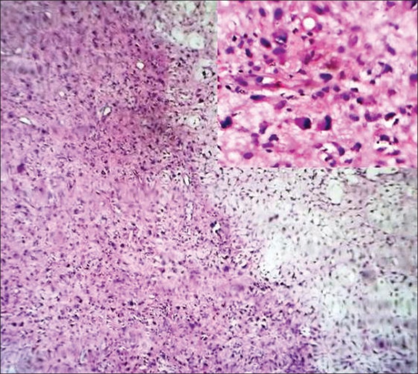 Figure 4: One portion of the tumor showing cells with pseudomalignant
features; H and E ×100 (inset; H and E ×400)
