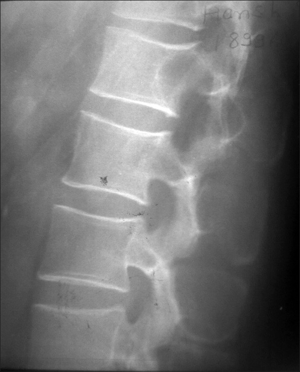 Figure 4: X‑ray of the Dorso‑lumbar region showing significant
scalloping of posterior margin of L1 vertebral bodies and their posterior
elements