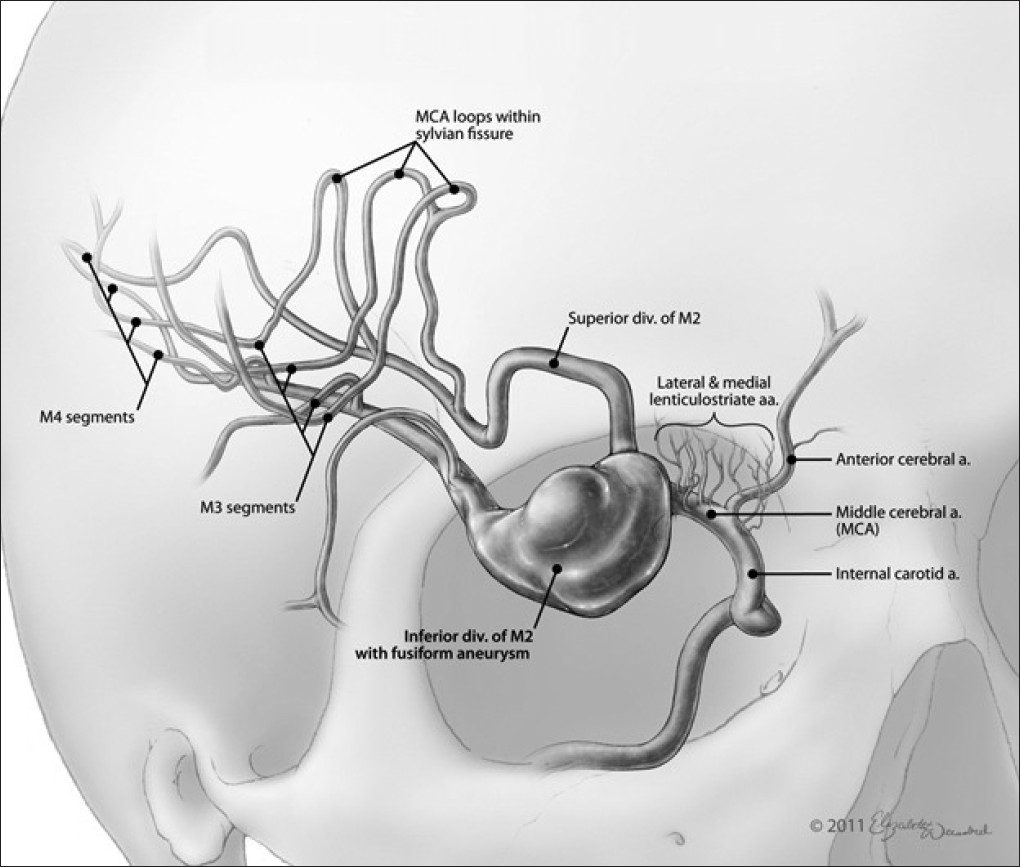 Figure 2: Artistic rendition of the giant fusiform aneurysm of the inferior M2 division