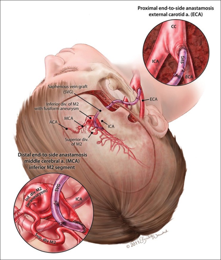 Figure 3: Artistic rendition of the end to side anastomosis with the ECA