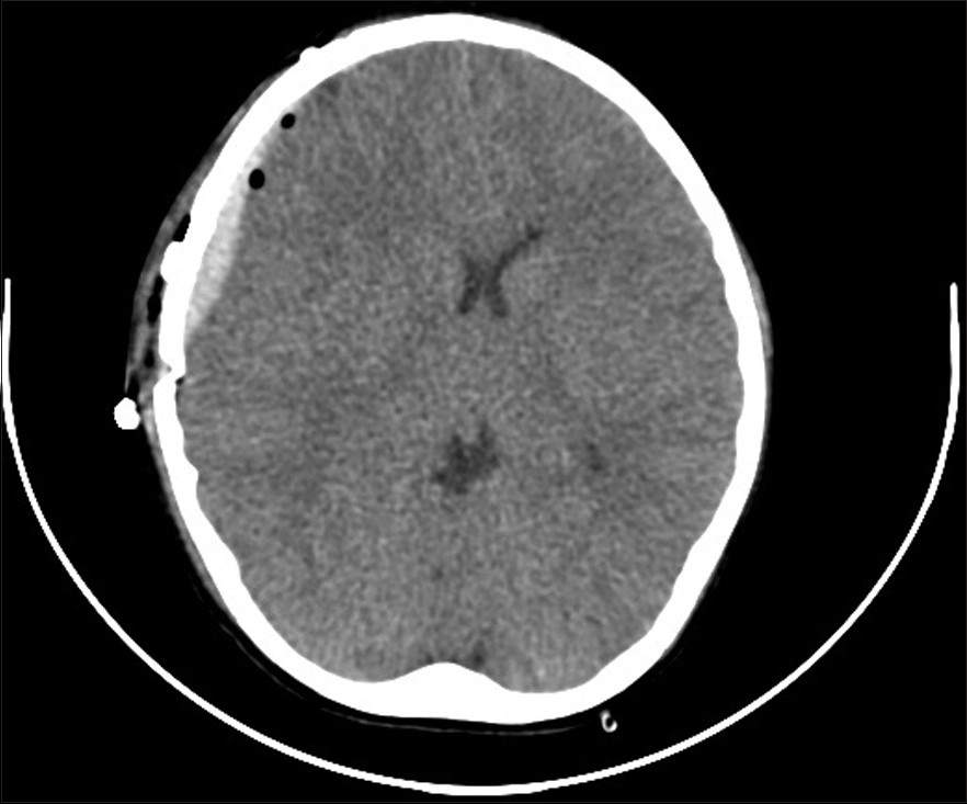 Figure 4: Immediate postoperative CT scan