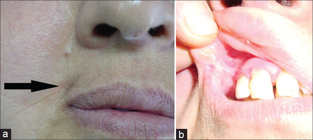 Figure 1: (a,b) A 56‑year‑old woman presented with a scar in the right upper gingivobuccal sulcus, involving the right commissure of the mouth