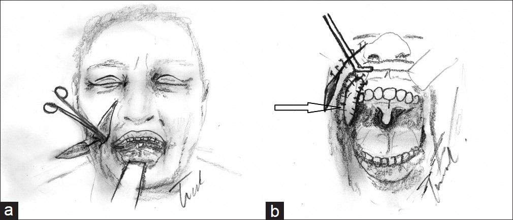 Figure 2: (a) During the operation, after release of the scar a nasolabial flap with a diameter of 2 cm was prepared on the same side. (b) The flap was tunnelized to fill up the defect, just superior to the commissure.
The tunnel from the cheek skin through the buccal mucosa was made by blunt scissor dissection