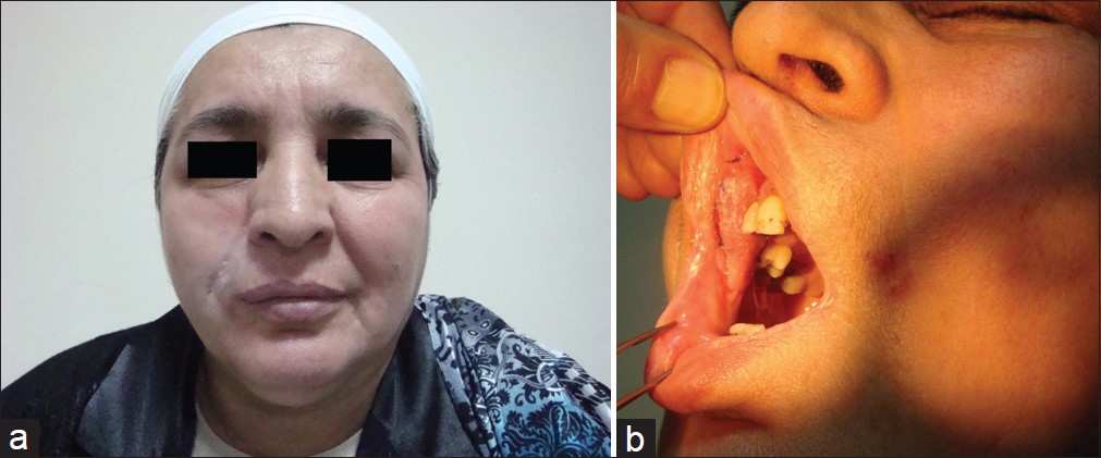 Figure 3: (a) Early postoperative result at one month. Some edema is present around the modiolus. (b) The appearance of the flap in the mouth was considered to be satisfactory
