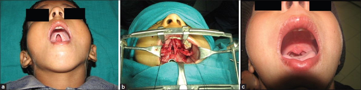 Figure 1: (a) Pre-operative cleft palate; (b) Pinto's modification of Wardill-Kilner two-layer palatoplasty; (c) Post– operative 6 weeks