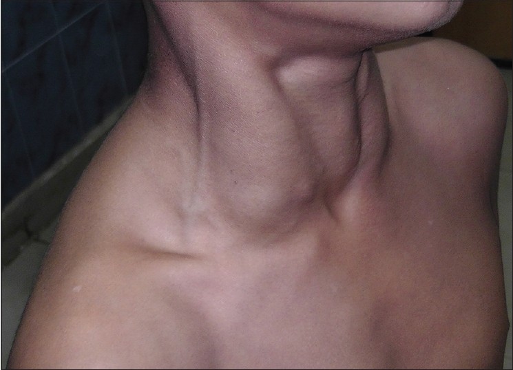 Figure 1: During Valsalva maneuver, apparent swelling seen on the right side of the neck
