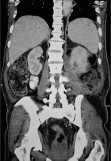 Figure 1: CECT with coronal reconstruction showing emphysematous pyelonephritis of left kidney