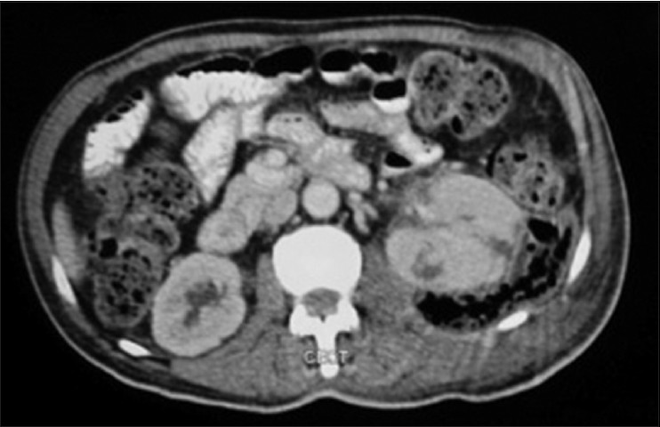Figure 2: CECT showing emphysematous pyelonephritis of left kidney