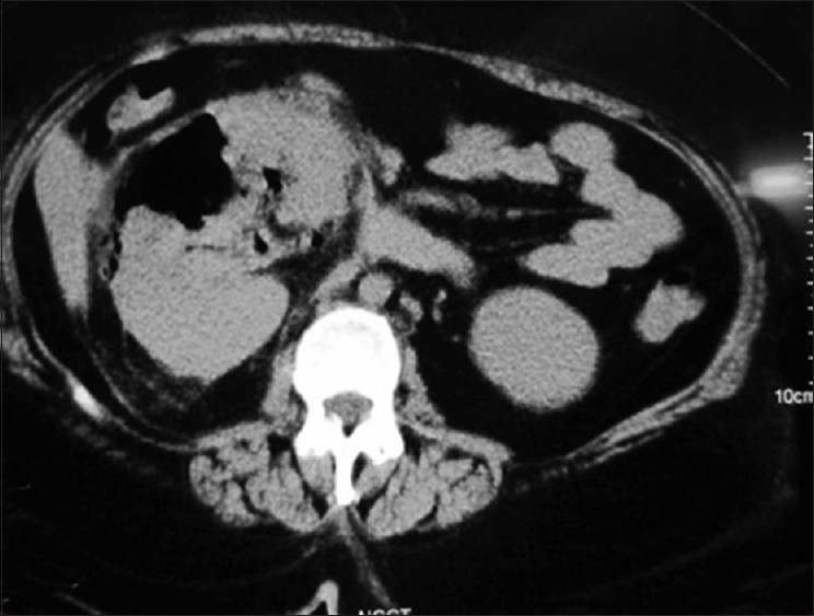 Figure 3: CECT showing emphysematous pyelonephritis of right kidney