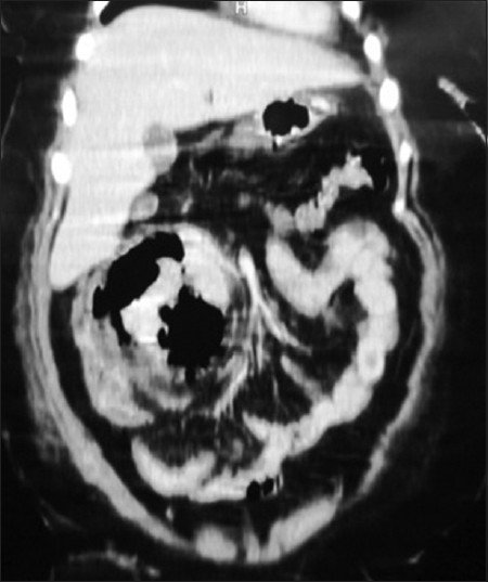 Figure 4: CECT with coronal reconstruction showing emphysematous pyelonephritis of right kidney
