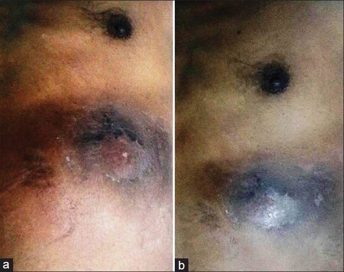 Figure 1: (a) Abscess over the left lower chest wall at presentation (before incision and drainage); (b) Abscess over the left lower chest wall after incision and drainage and antibiotics. There was a decrease in size, skin discoloration, swelling and showed signs of healing