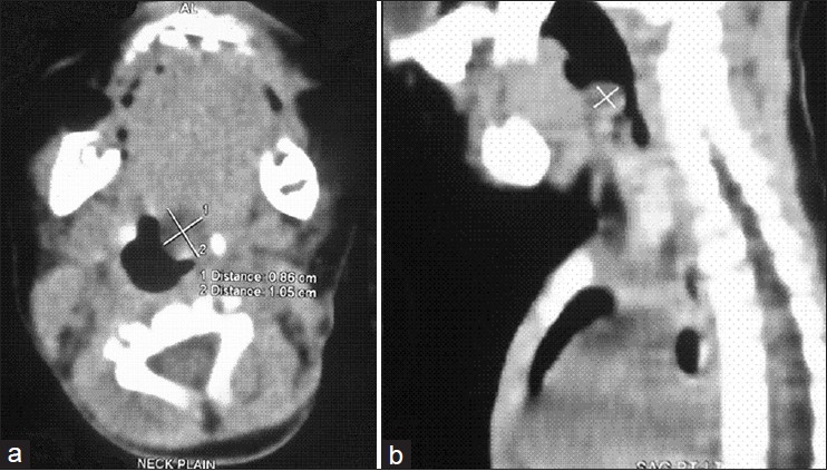 Figure 1: (a) Computerized tomography scan image (Transverse cut) showing left vallecular cyst. (b) CT scan image (Lateral view) showing left vallecular cyst
