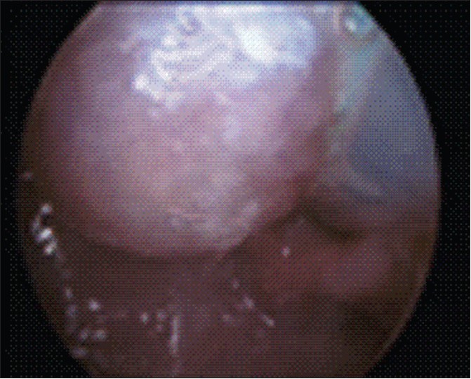 Figure 2: Endoscopic view showing left vallecular cyst