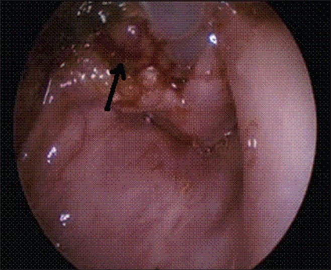 Figure 3: Endoscopic view after excision of the cyst (arrow)