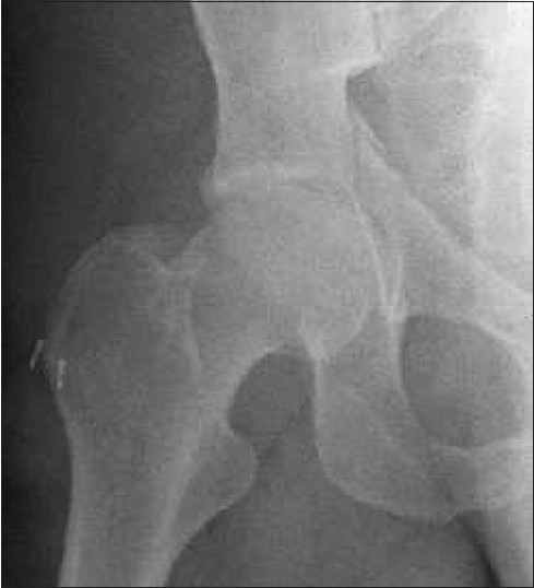 Figure 9: Post-operative plain-film radiographs showed very small bony fragments beside the entry point