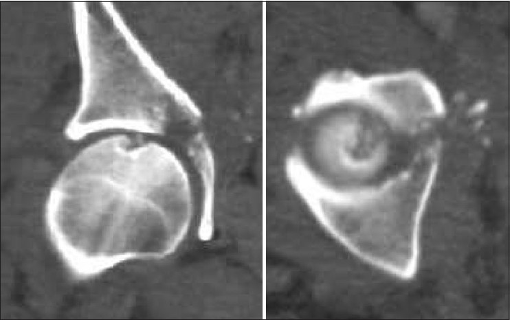Figure 10: Post-operative computed tomography scan showed very small bony fragments beside the entry point