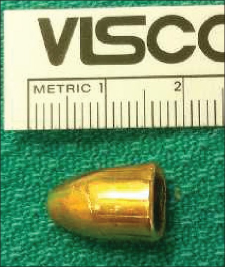 Figure 1: The bullet after retrieval from the hip joint