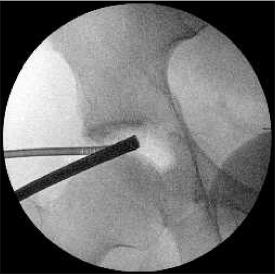 Figure 8: Intraoperative fluoroscopy verified removal of almost the entire fragment