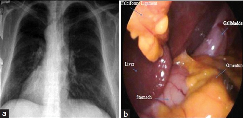 Figure 1: (a) Plane chest X‑ray demonstrates dextrocardia and (b) laparoscopic view of situs inversus totalis