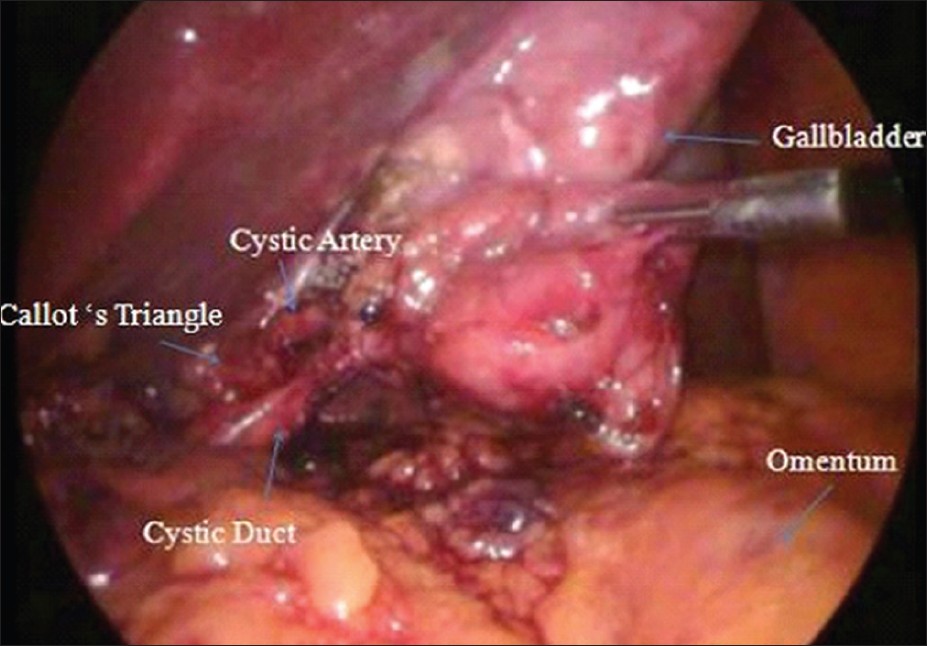 Figure 2: Laparoscopic view of Callot's triangle after meticulous dissection
