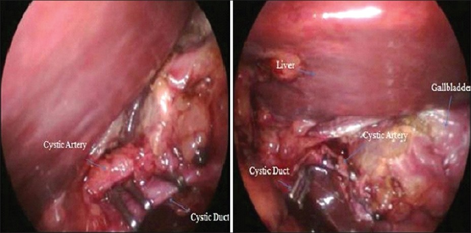 Figure 3: Laparoscopic view of the cystic duct and the cystic artery