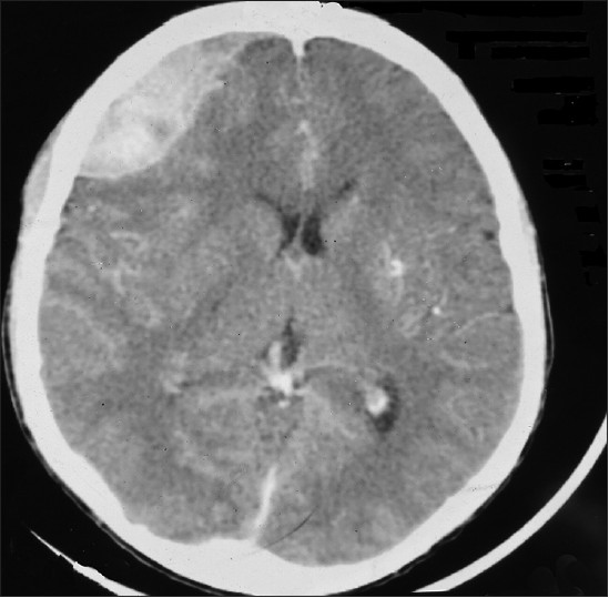 Figure 1: Brain computed tomography scan showing right frontal acute epidural Haematoma