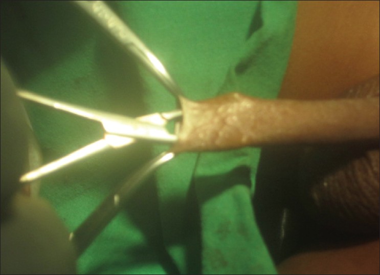 Figure 1: Dilating the preputial orifice and separating adhesions