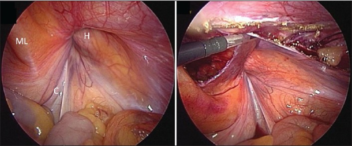 Figure 1: Peritoneal flap being developed using a transverse peritoneal incision placed above the hernial orifice (h); ML = Medial umbilical ligament; C = cord structures