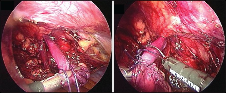 Figure 2: Hernia sac separated from cord structures, ligated and transected, allowing sac to remain in situ without dissection into the scrotum