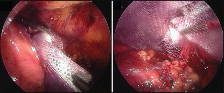 Figure 3: Lightweight polyester mesh introduced into the pre‑peritoneal pocket, positioned over the hernial orifices and fixated with endoscopic tackers starting at the retropubic space of Retzius