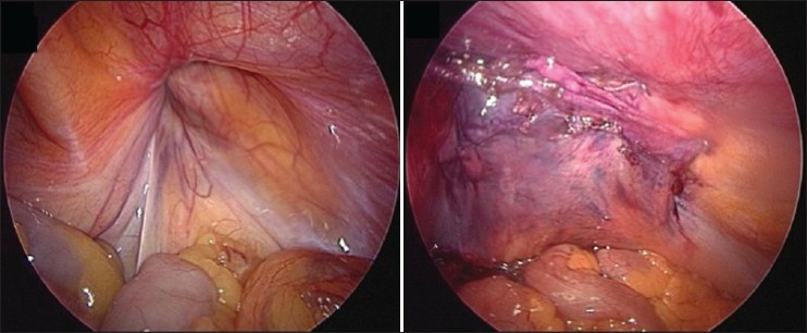 Figure 4: Laparoscopic view of right inguinal region pre and post laparoscopic TAPP repair