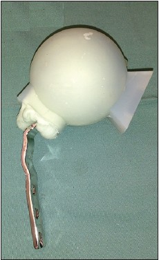 Figure 3: The technique is demonstrated with a Biomet® silicon mold. The mold is cut with scissors through the spacer neck area. Antibiotic‑loaded bone cement is first inserted into the head mold and
then the bended plate is inserted. The depth of the insertion is defined in accordance with the offset adjustment required in a particular case
