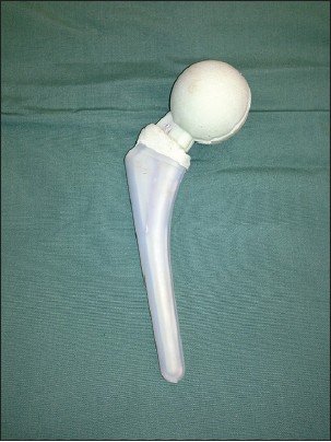Figure 5: The gap between the mold parts is manually filled with antibiotic‑loaded bone. This cement ring should be broader than the spacer stem in order to act (1) as a bearing base onto the proximal
femur, which might prevent possible sintering of the spacer into the femur and (2) contribute to the preservation of an adequate muscle tension