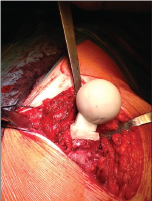 Figure 6: After hardening of the cement, the spacer is removed from the mold and inserted into the femur