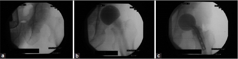 Figure 7: Intraoperative X‑rays demonstrating the adjustment of the femoral offset in a case of acetabulum osteomyelitis with subsequent septic hip joint arthritis. (a) The natural joint at the beginning of the surgery. (b) If a normal spacer is implanted, a decrease of the femoral offset is evident (notice the distance between the calcar and the os ischium). (c) By implanting a spacer according to the present technique, the femoral offset is increased