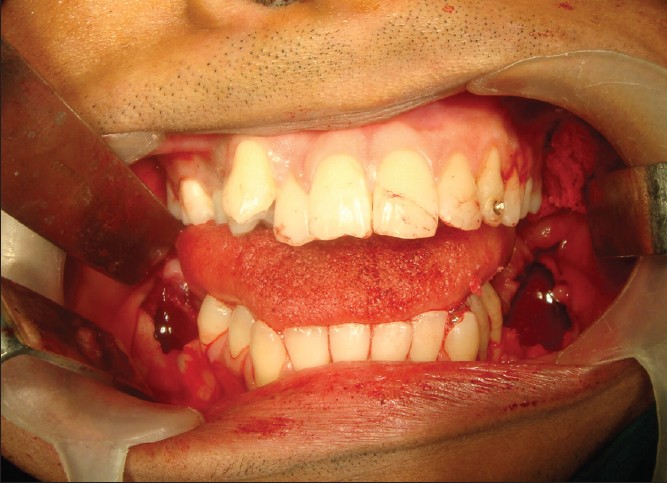 Figure 10: Intraoperative clinical photograph showing resultant bony cavities after enucleation of dentigerous cysts in mandible
