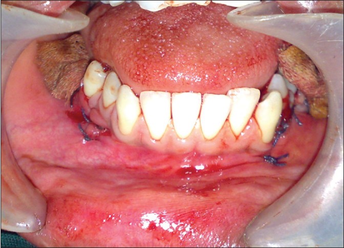 Figure 11: Postoperative clinical photograph showing the gauze packed in to the bony cavities after cyst enucleation