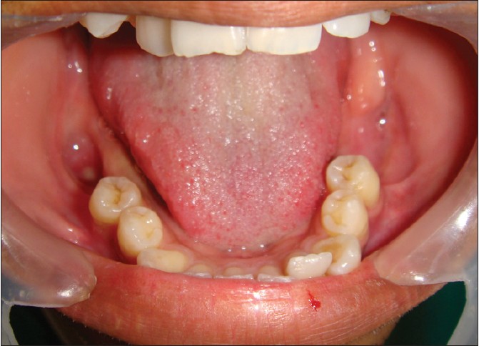 Figure 12: Intraoral clinical view after 6 months showing the healing of bony cavities