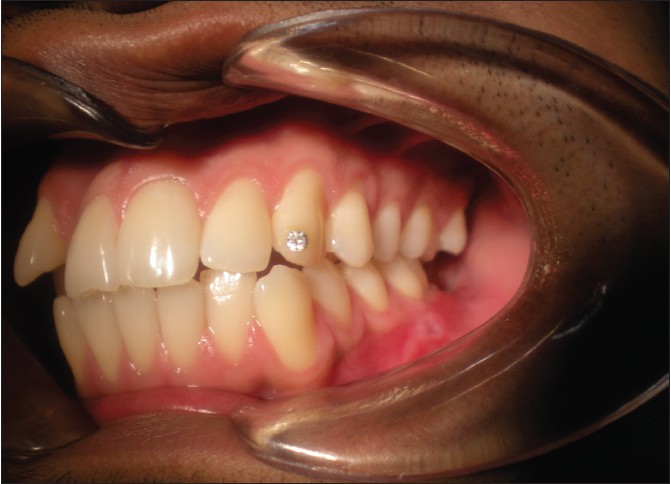 Figure 2: Preoperative clinical photographs showing intraoral swellings in the retromolar area on left side