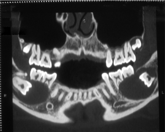 Figure 3: CT image showing bilateral expansile radiolucent lesion surrounding both the mandibular and maxillary third molar regions along with supernumerary teeth