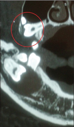 Figure 4: CT image shows maxillary radiolucent lesion surrounding the right impacted third molar