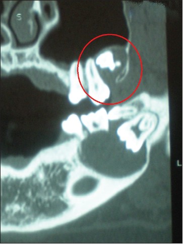 Figure 5: CT image shows maxillary radiolucent lesion surrounding the left impacted third molar