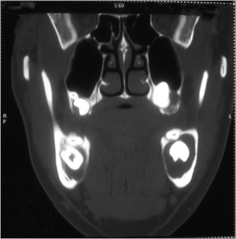 Figure 6: The coronal view of mandible in CT image shows bilateral lingual bone perforation
