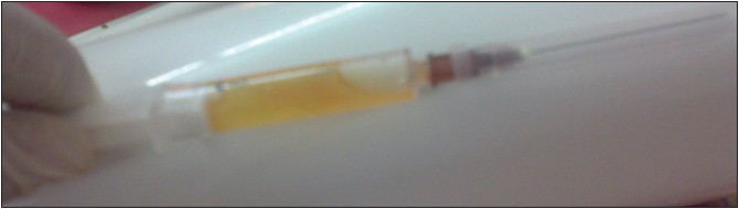 Figure 7: Cystic fluid aspirate shows straw‑colored fluid