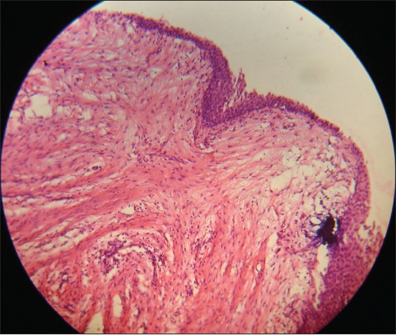 Figure 8: Histopathological section showing the cystic epithelial lining typically of dentigerous cyst